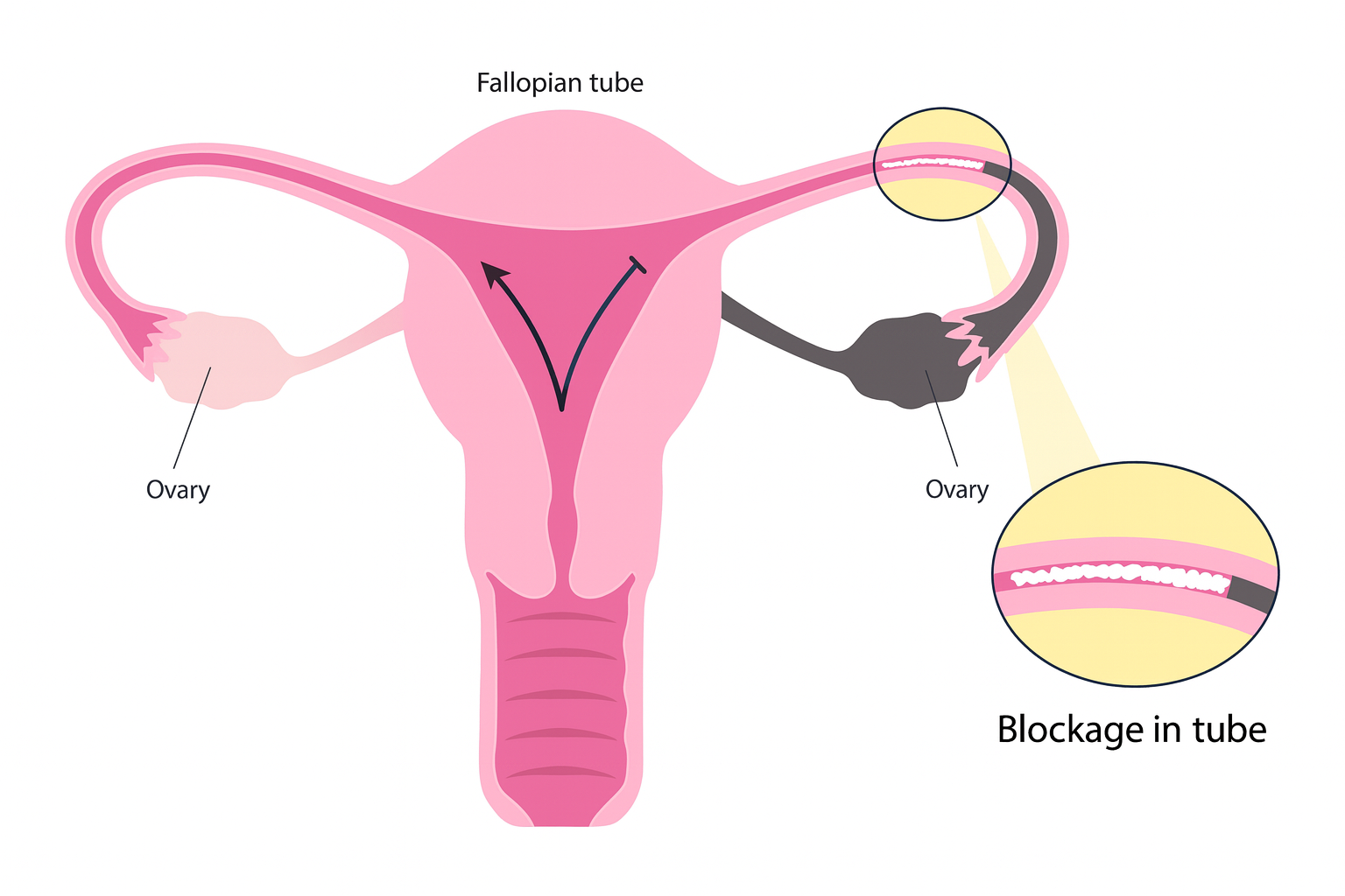Fallopian tube anatomy showing blockage